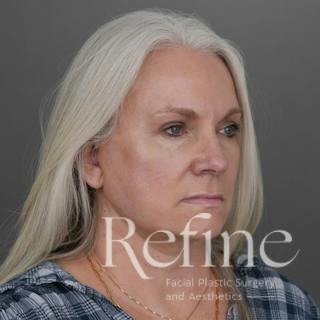 Deep Plane Facelift Before & After Gallery - Patient 137834 - Image 4