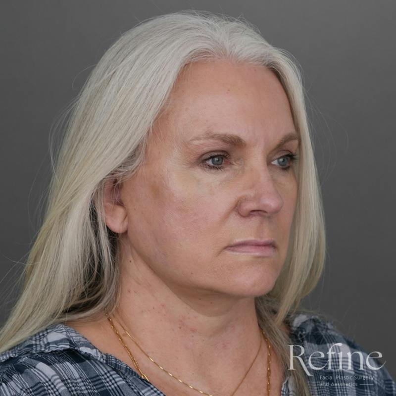 Deep Plane Facelift Before & After Gallery - Patient 137834 - Image 4