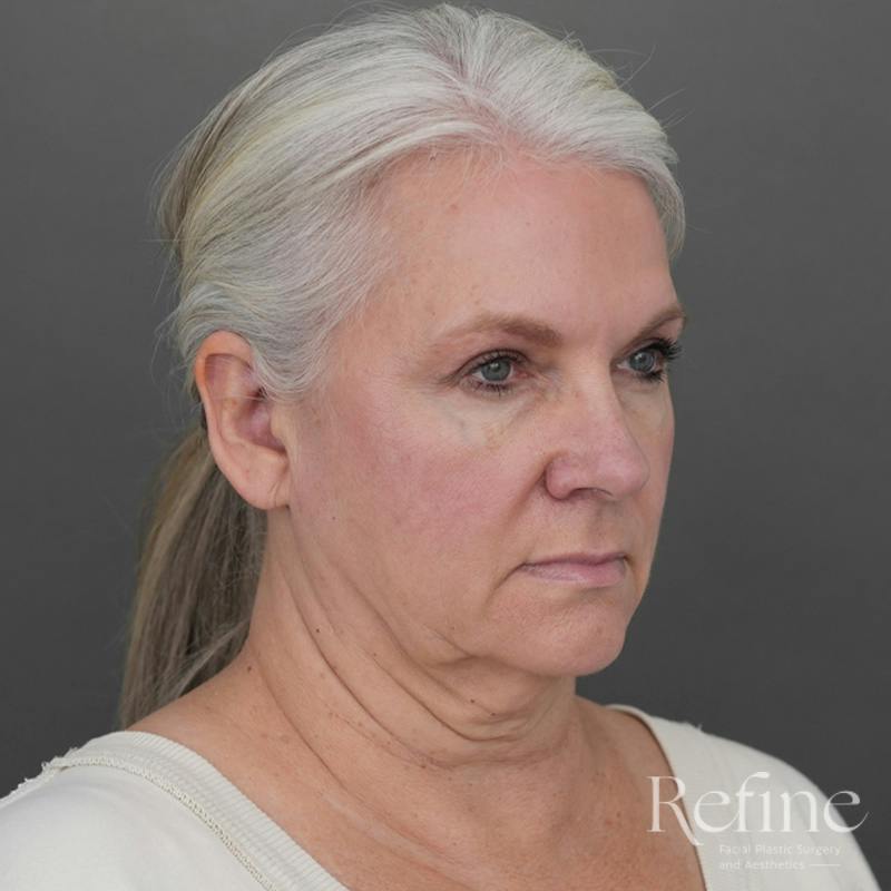 Deep Plane Facelift Before & After Gallery - Patient 137834 - Image 3