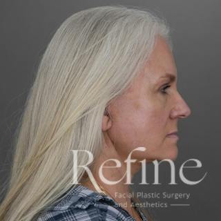 Deep Plane Facelift Before & After Gallery - Patient 137834 - Image 2