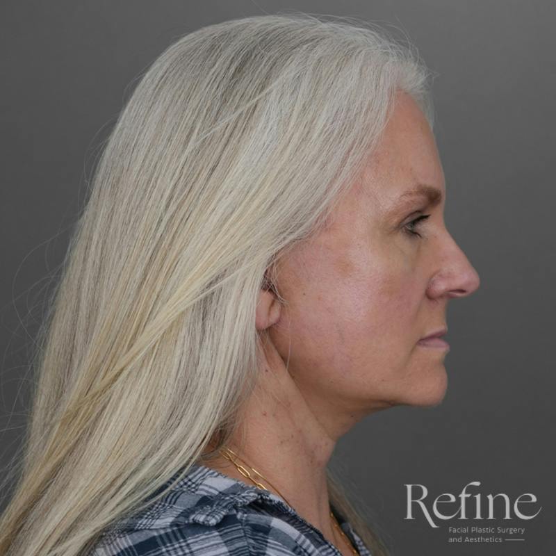 Deep Plane Facelift Before & After Gallery - Patient 137834 - Image 2