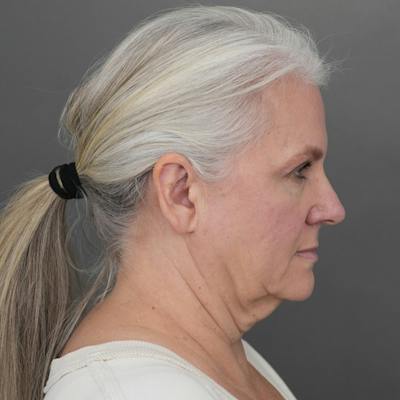 Deep Plane Facelift Before & After Gallery - Patient 137834 - Image 1
