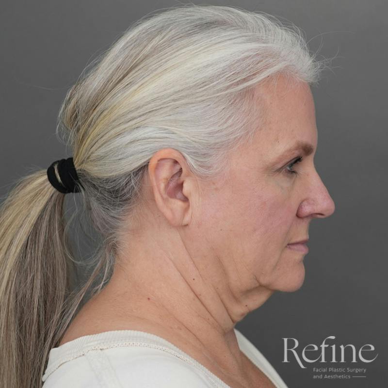 Deep Plane Facelift Before & After Gallery - Patient 137834 - Image 1