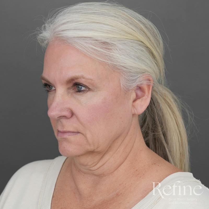 Deep Plane Facelift Before & After Gallery - Patient 137834 - Image 7