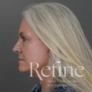 Deep Plane Facelift Before & After Gallery - Patient 137834 - Image 10