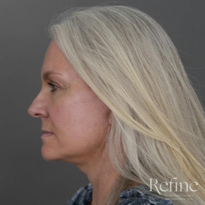 Deep Plane Facelift Before & After Gallery - Patient 137834 - Image 10