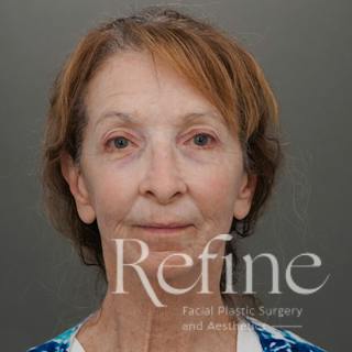 Facial Fat Grafting Before & After Gallery - Patient 373670 - Image 2