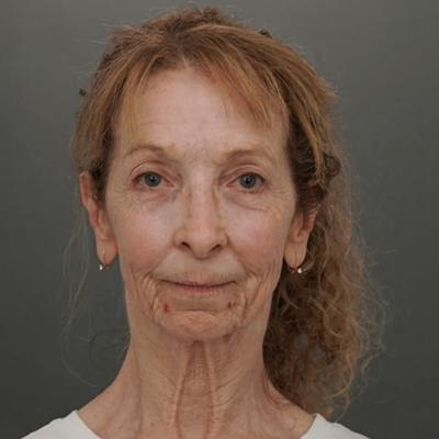 Facial Fat Grafting Before & After Gallery - Patient 373670 - Image 1