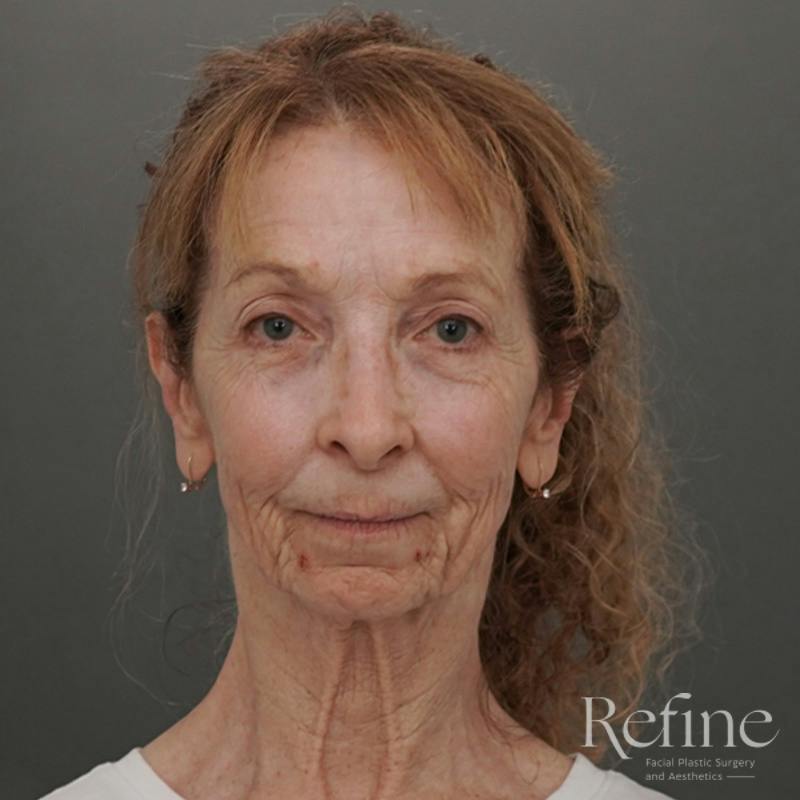 Facial Fat Grafting Before & After Gallery - Patient 373670 - Image 1