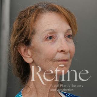 Facial Fat Grafting Before & After Gallery - Patient 373670 - Image 4