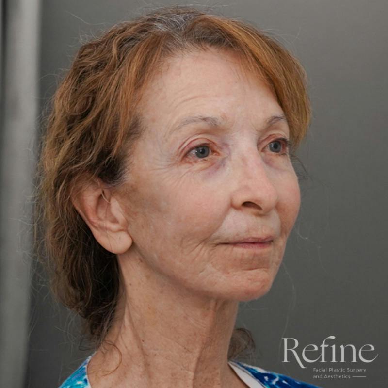 Facial Fat Grafting Before & After Gallery - Patient 373670 - Image 4
