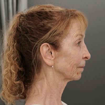 Deep Plane Facelift Before & After Gallery - Patient 139984 - Image 1