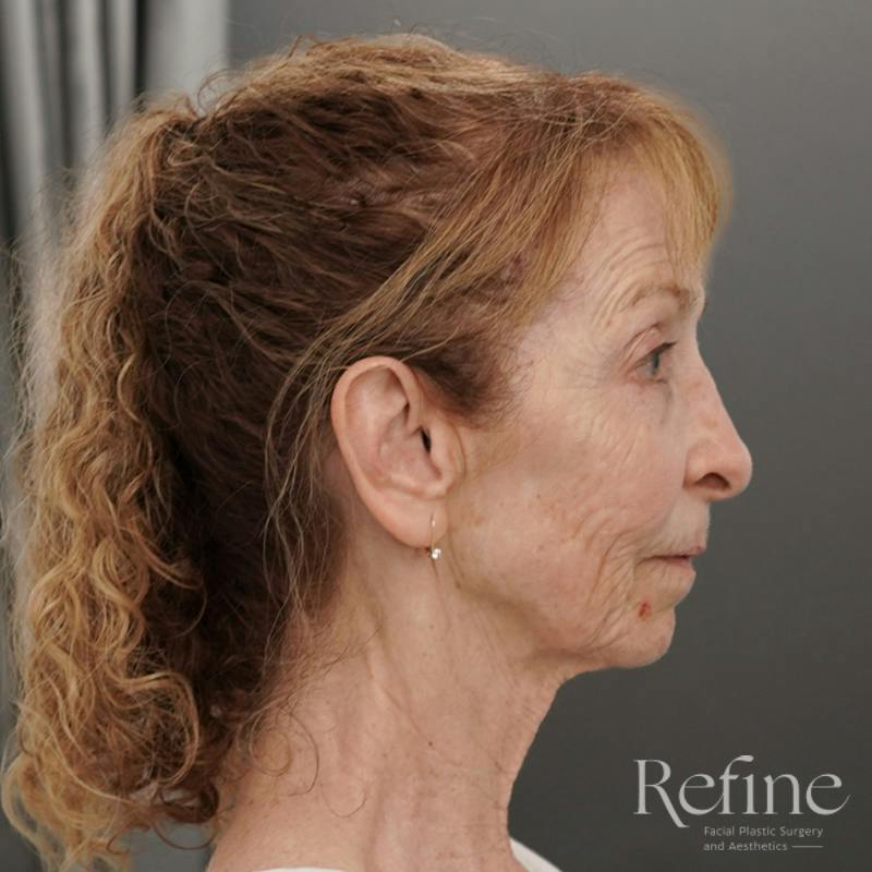 Facial Fat Grafting Before & After Gallery - Patient 373670 - Image 5