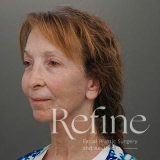 Facial Fat Grafting Before & After Gallery - Patient 373670 - Image 8