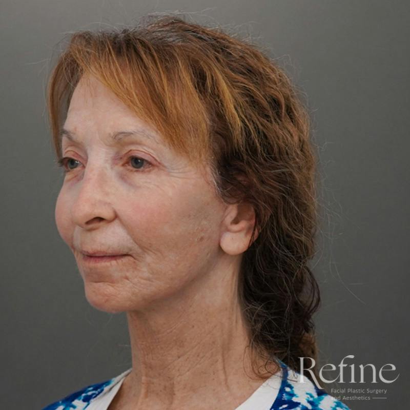 Facial Fat Grafting Before & After Gallery - Patient 373670 - Image 8