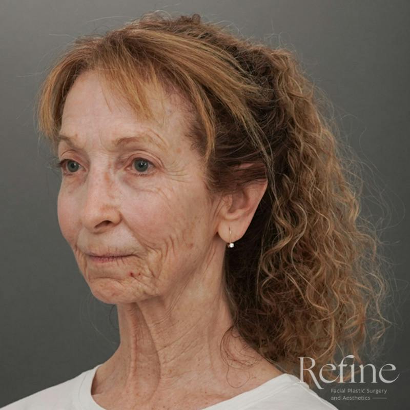 Facial Fat Grafting Before & After Gallery - Patient 373670 - Image 7