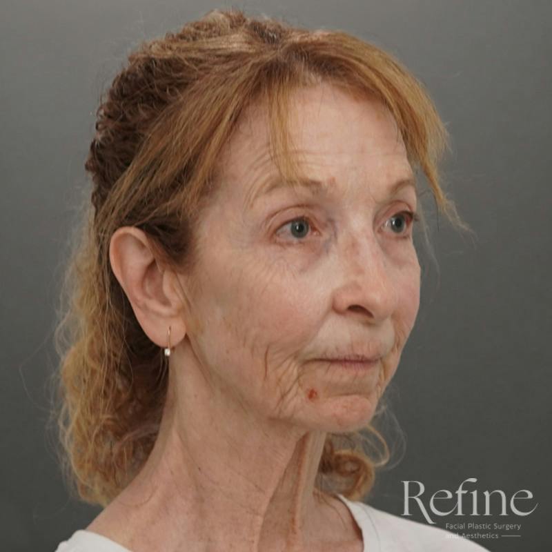 Facial Fat Grafting Before & After Gallery - Patient 373670 - Image 3