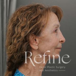 Facial Fat Grafting Before & After Gallery - Patient 373670 - Image 6