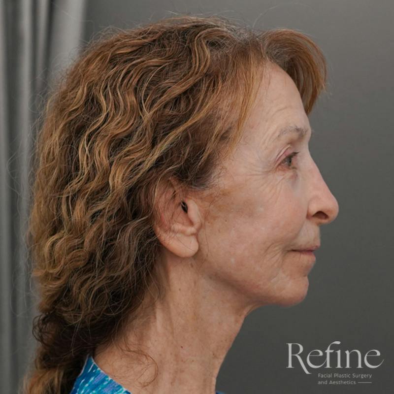 Facial Fat Grafting Before & After Gallery - Patient 373670 - Image 6