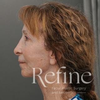 Facial Fat Grafting Before & After Gallery - Patient 373670 - Image 10