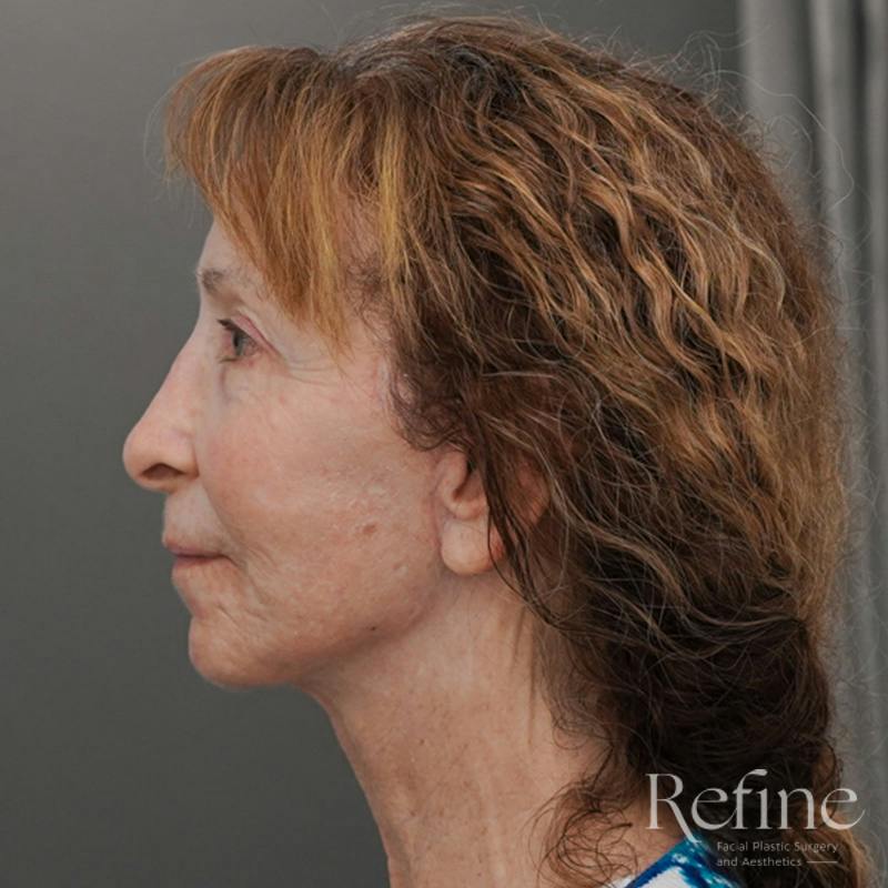 Facial Fat Grafting Before & After Gallery - Patient 373670 - Image 10