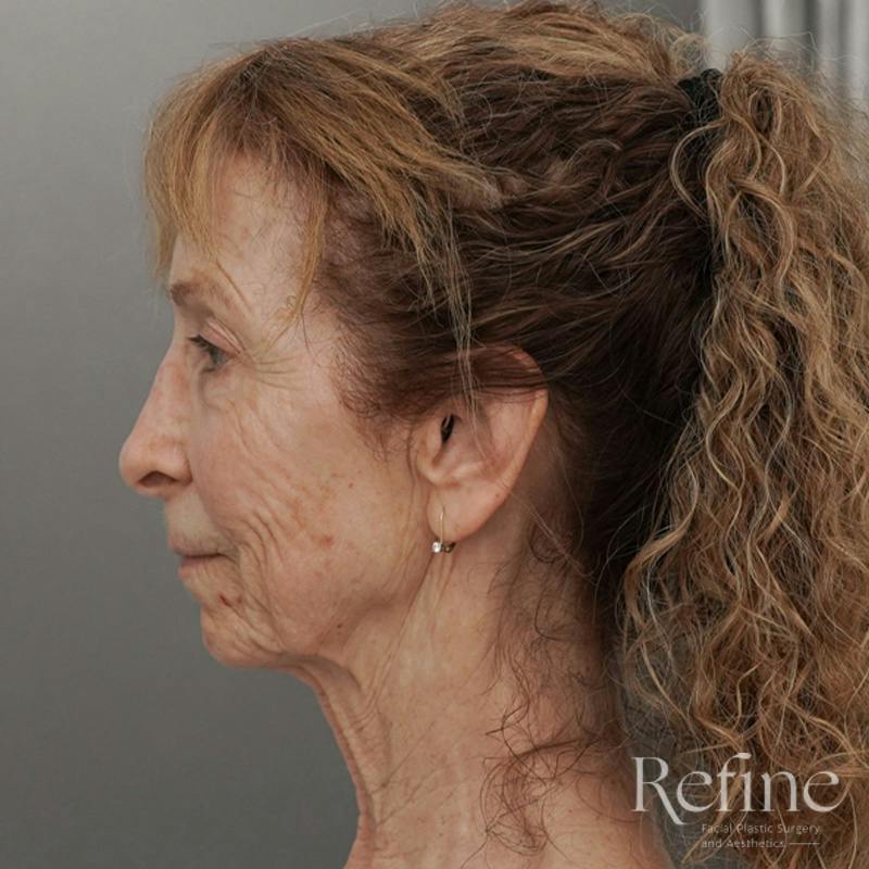 Facial Fat Grafting Before & After Gallery - Patient 373670 - Image 9