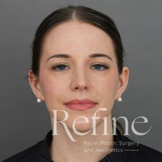 Rhinoplasty Before & After Gallery - Patient 419147 - Image 6
