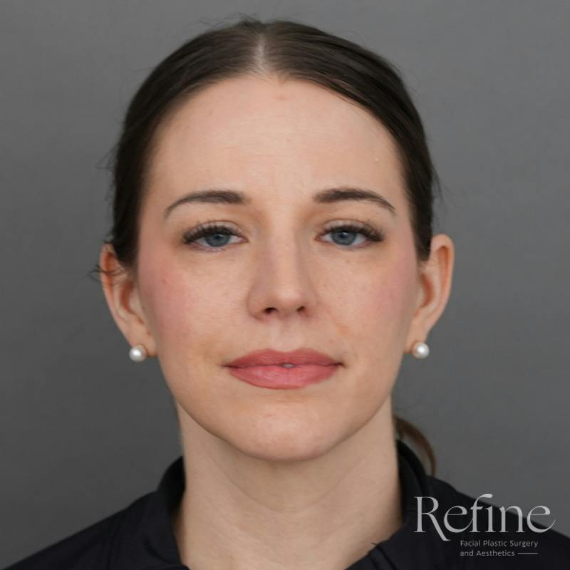 Rhinoplasty Before & After Gallery - Patient 419147 - Image 6