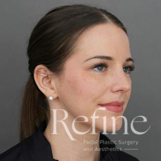 Rhinoplasty Before & After Gallery - Patient 419147 - Image 4