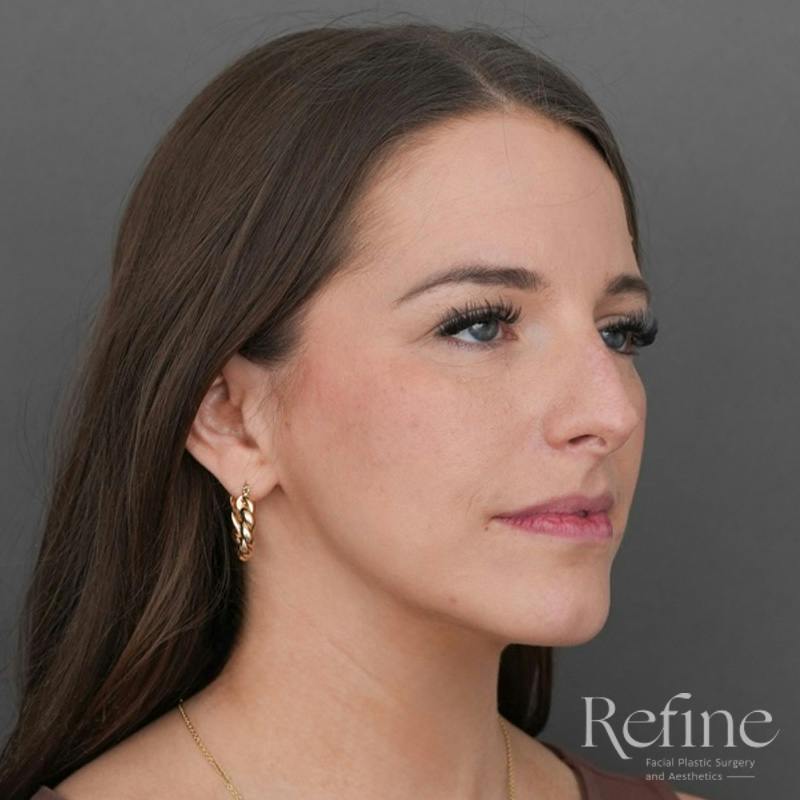 Rhinoplasty Before & After Gallery - Patient 419147 - Image 3