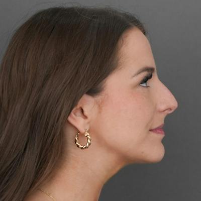 Rhinoplasty Before & After Gallery - Patient 419147 - Image 1