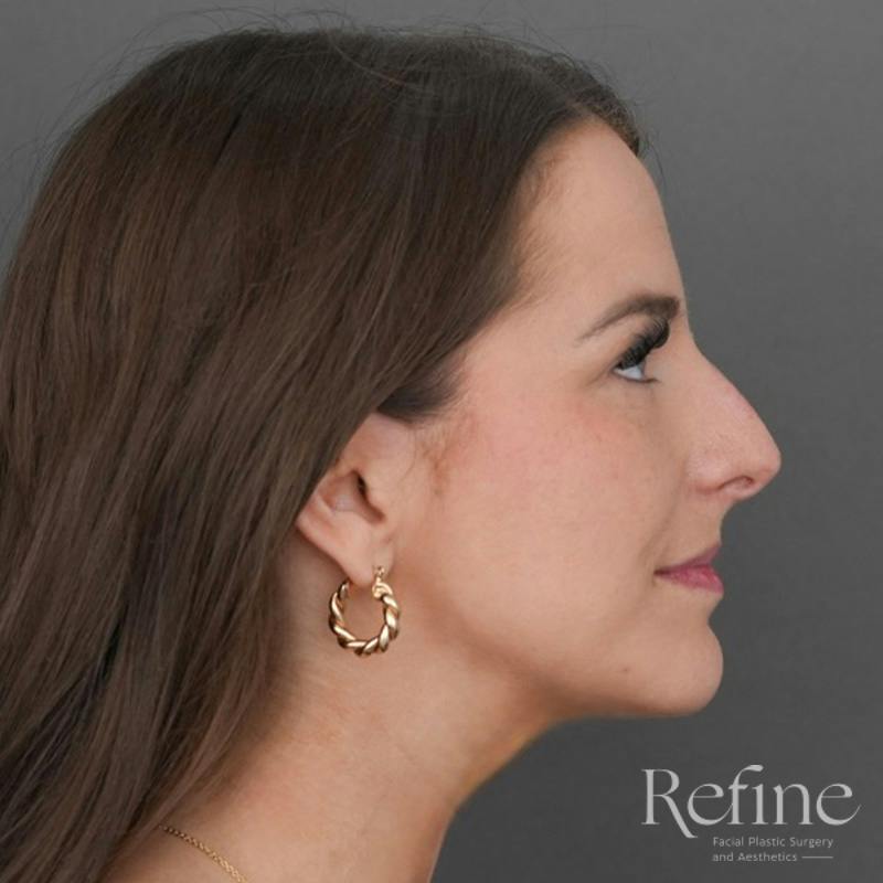 Rhinoplasty Before & After Gallery - Patient 419147 - Image 1