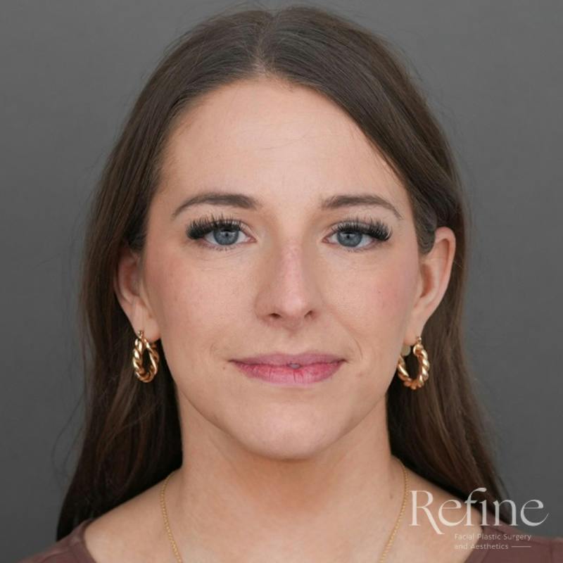 Rhinoplasty Before & After Gallery - Patient 419147 - Image 5