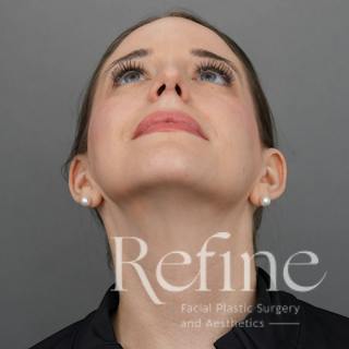 Rhinoplasty Before & After Gallery - Patient 419147 - Image 8
