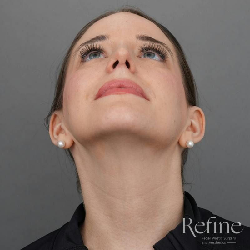 Rhinoplasty Before & After Gallery - Patient 419147 - Image 8