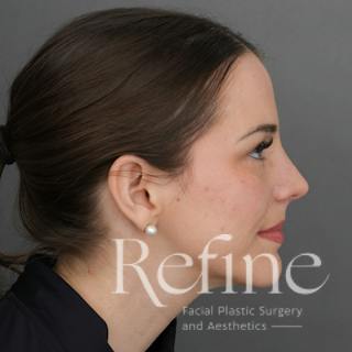 Rhinoplasty Before & After Gallery - Patient 419147 - Image 2