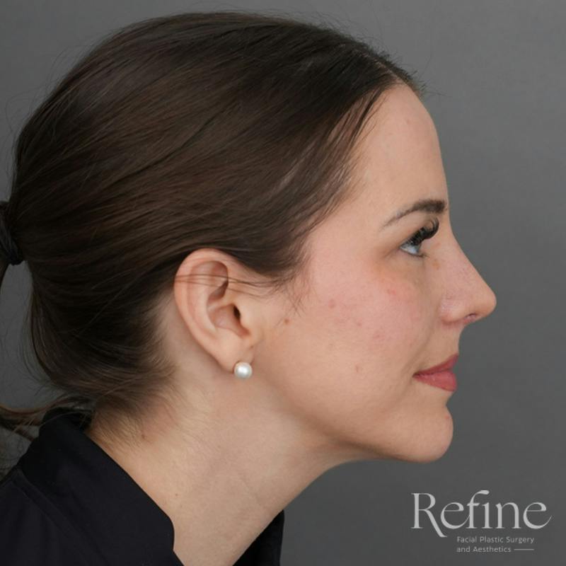 Rhinoplasty Before & After Gallery - Patient 419147 - Image 2
