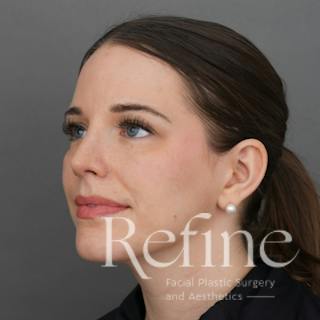 Rhinoplasty Before & After Gallery - Patient 419147 - Image 10