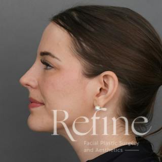 Rhinoplasty Before & After Gallery - Patient 419147 - Image 12