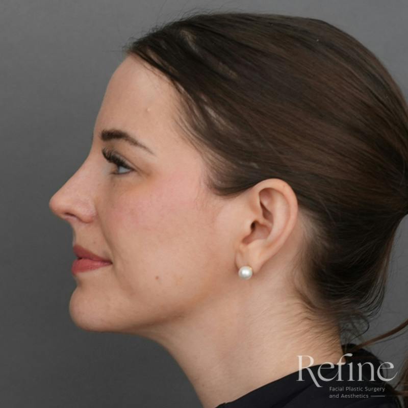 Rhinoplasty Before & After Gallery - Patient 419147 - Image 12