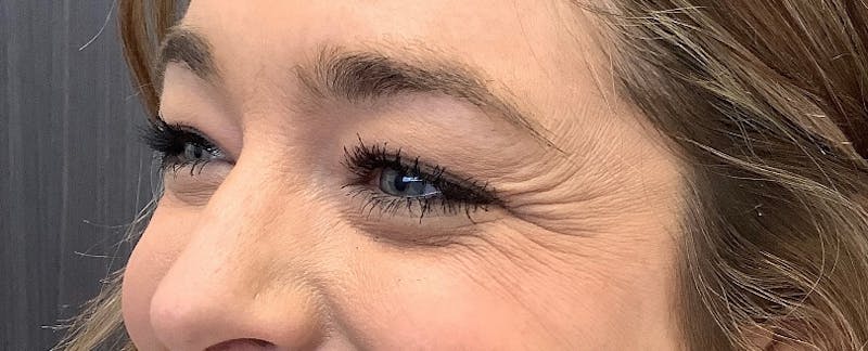 Injectables Before & After Gallery - Patient 189631 - Image 1