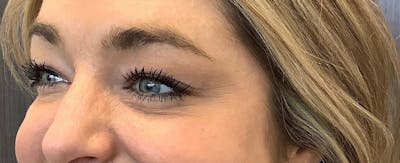 Injectables Before & After Gallery - Patient 189631 - Image 2