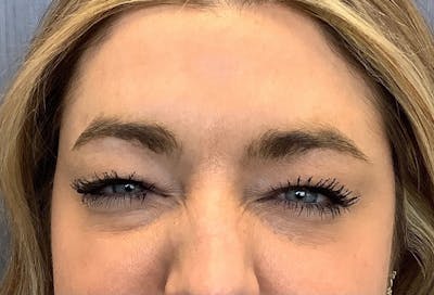 Injectables Before & After Gallery - Patient 231427 - Image 2