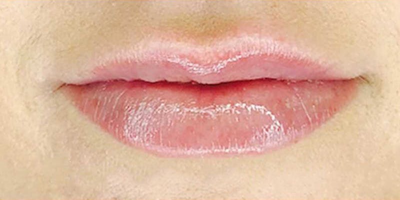 Injectables Before & After Gallery - Patient 336257 - Image 2