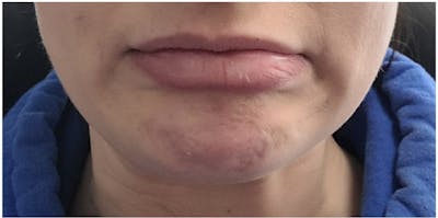 Injectables Before & After Gallery - Patient 218667 - Image 1