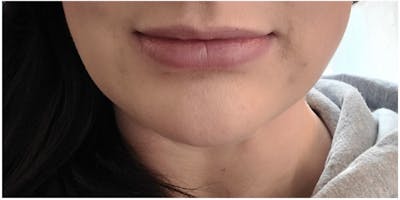 Injectables Before & After Gallery - Patient 218667 - Image 2