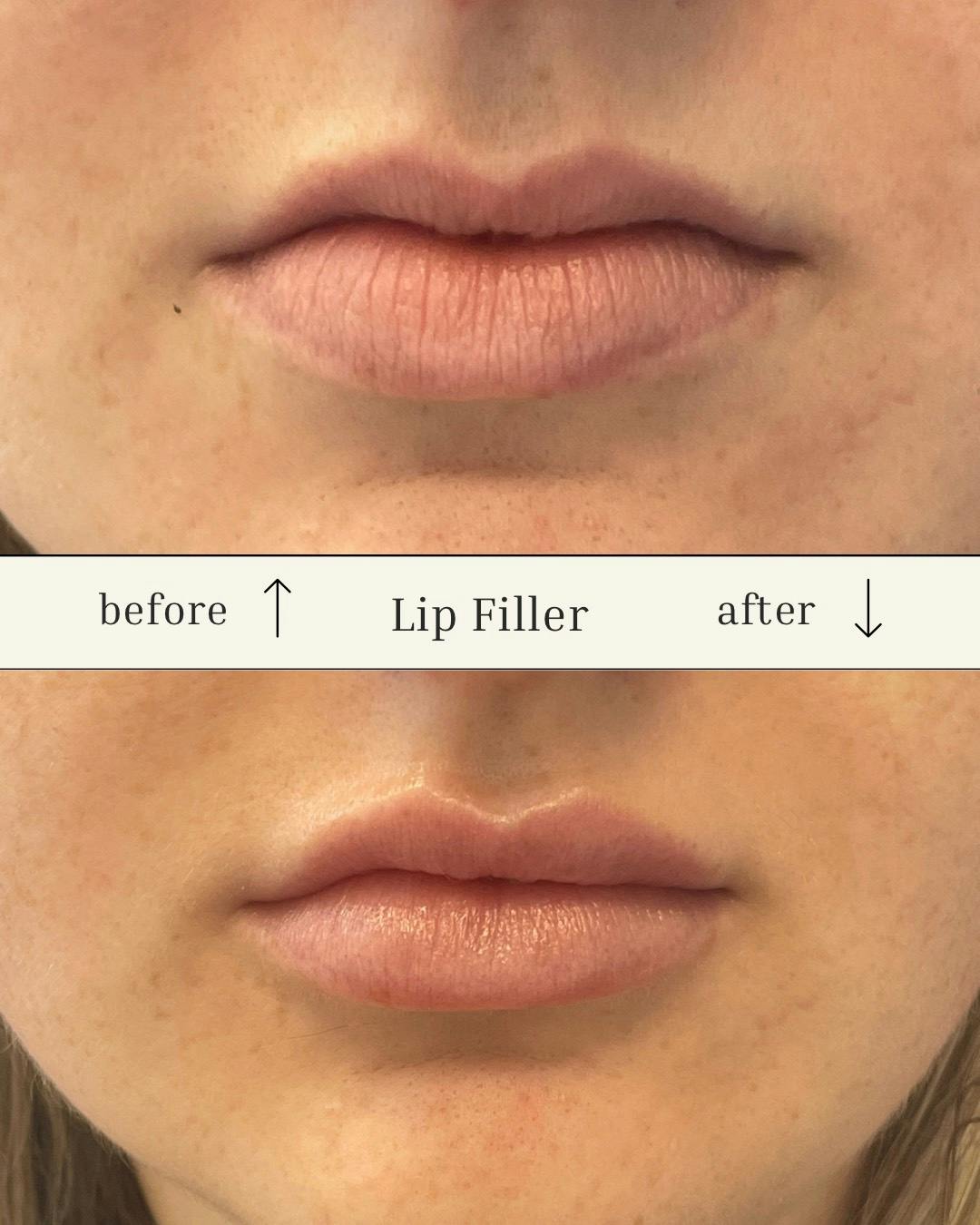 Injectables Before & After Gallery - Patient 317376 - Image 1