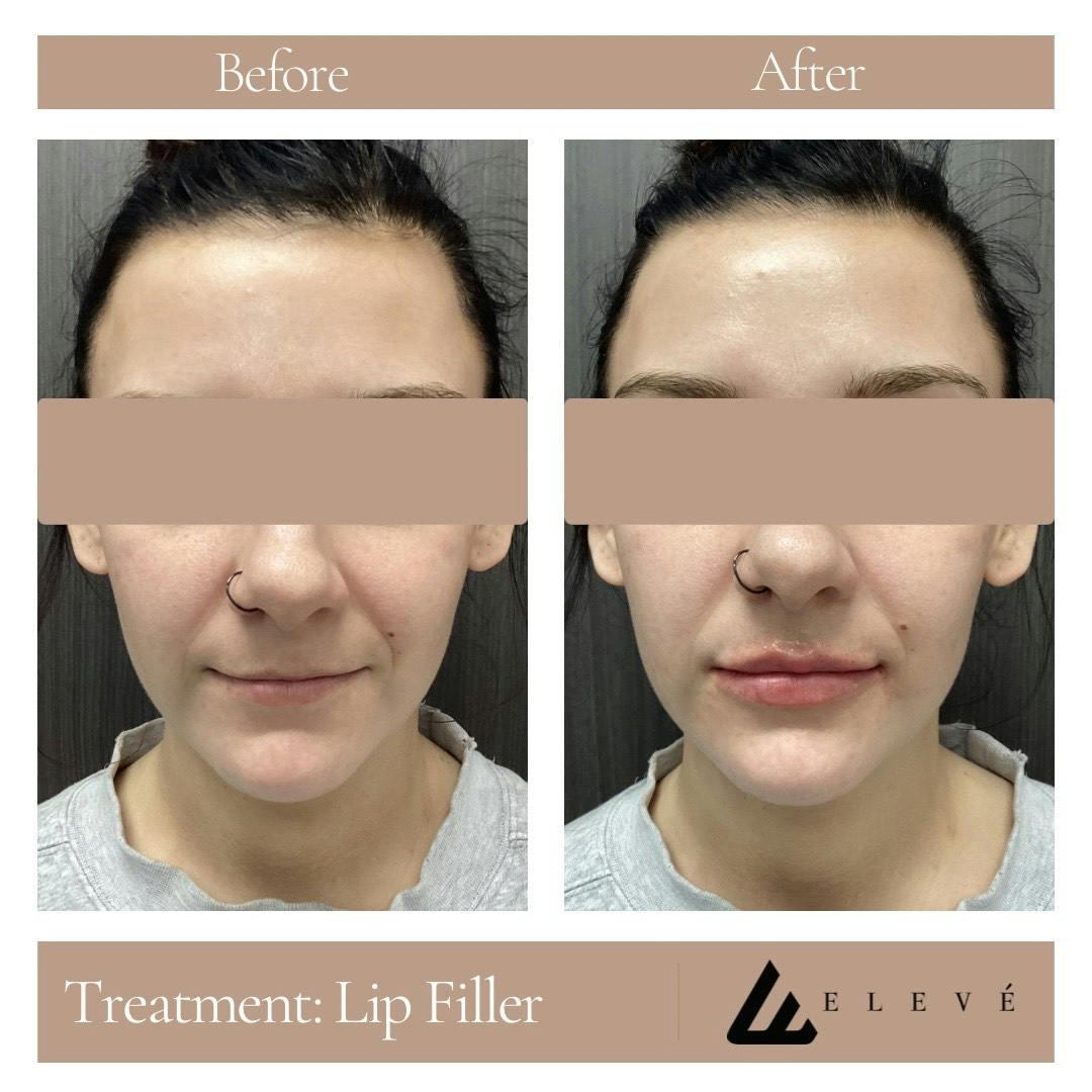 Injectables Before & After Gallery - Patient 107203 - Image 1
