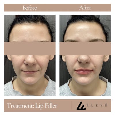 Injectables Before & After Gallery - Patient 107203 - Image 1