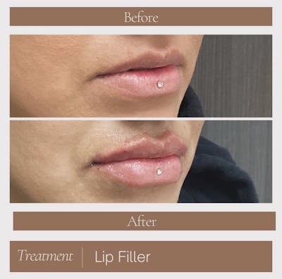 Injectables Before & After Gallery - Patient 134269 - Image 1